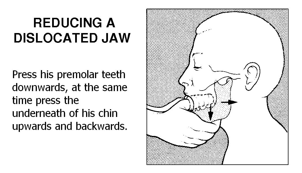 Mandíbula travada: confira o que é como destravar o maxilar!